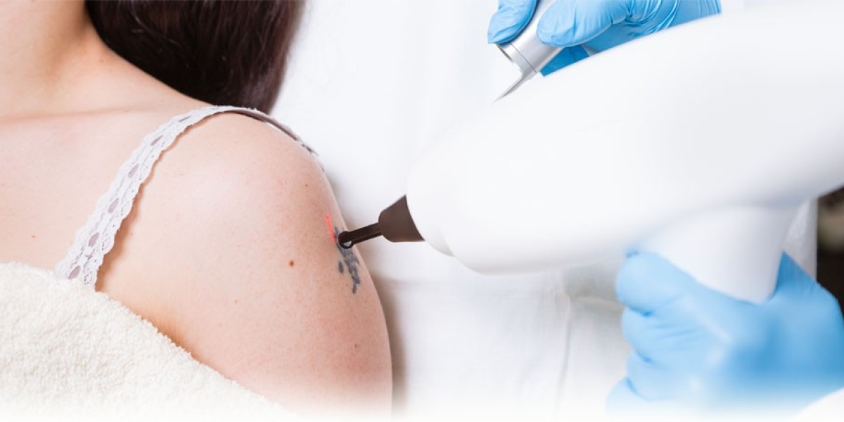 Laser Tattoo Removal in Dubai: A Game-Changer for Your Skin
