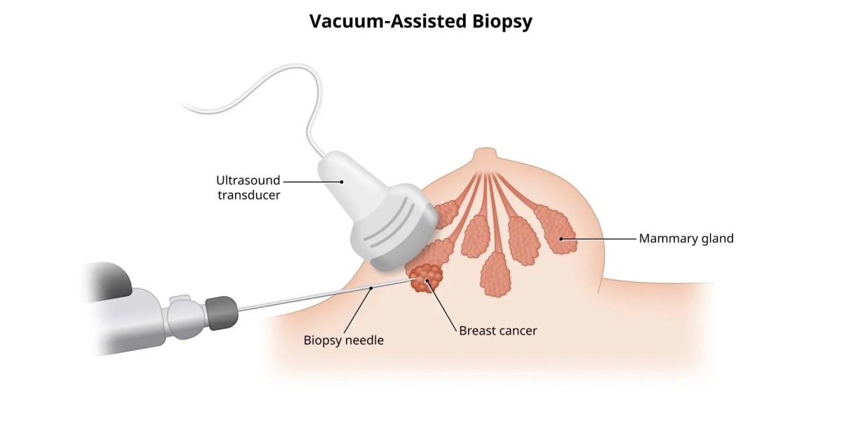 Minimally Invasive Biopsy for Diagnostic Purposes: A Modern Approach