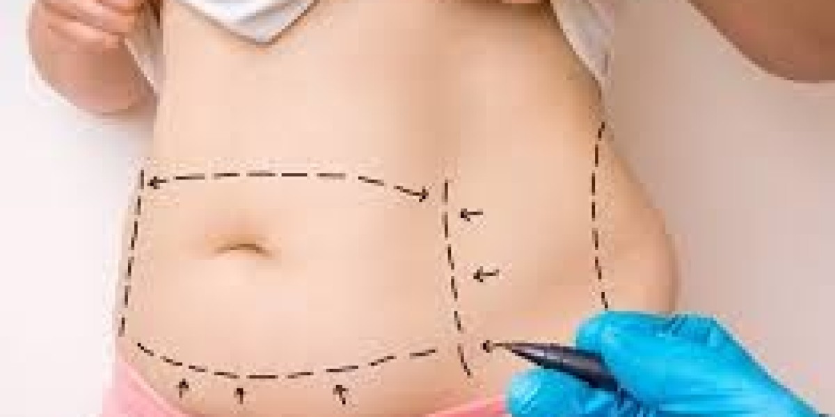 The Ultimate Post-Baby Makeover – Tummy Tuck in Dubai