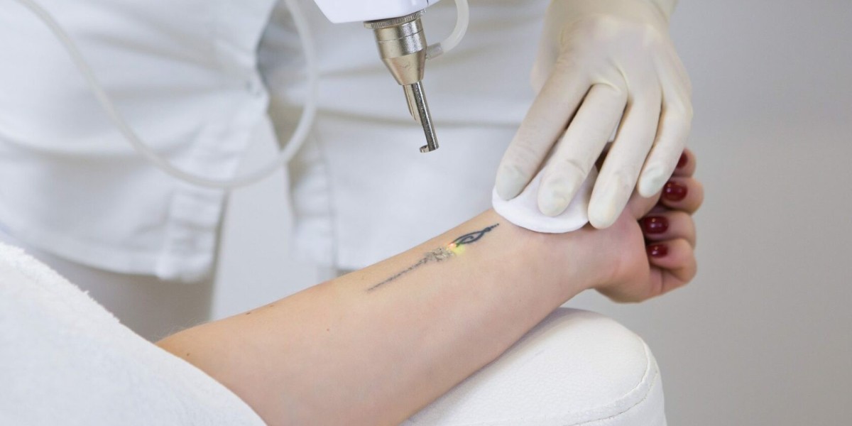 How to Care for Your Skin After Laser Tattoo Removal in Riyadh