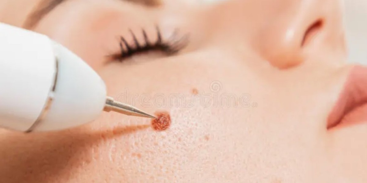 The Latest Mole Removal Technologies Available in Riyadh
