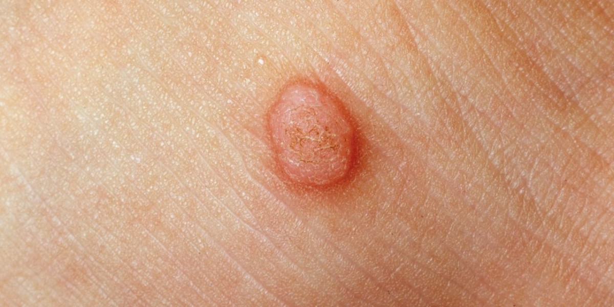 Understanding Wart Removal Costs: A Smart Buyer’s Guide