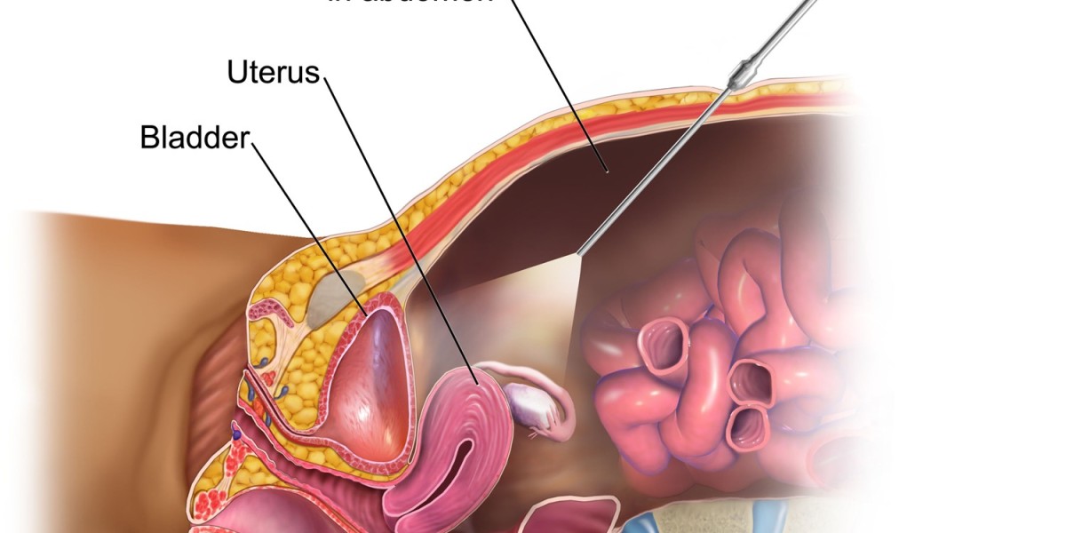 Laparoscopic Surgery in Riyadh vs. Open Surgery: Which is Better?