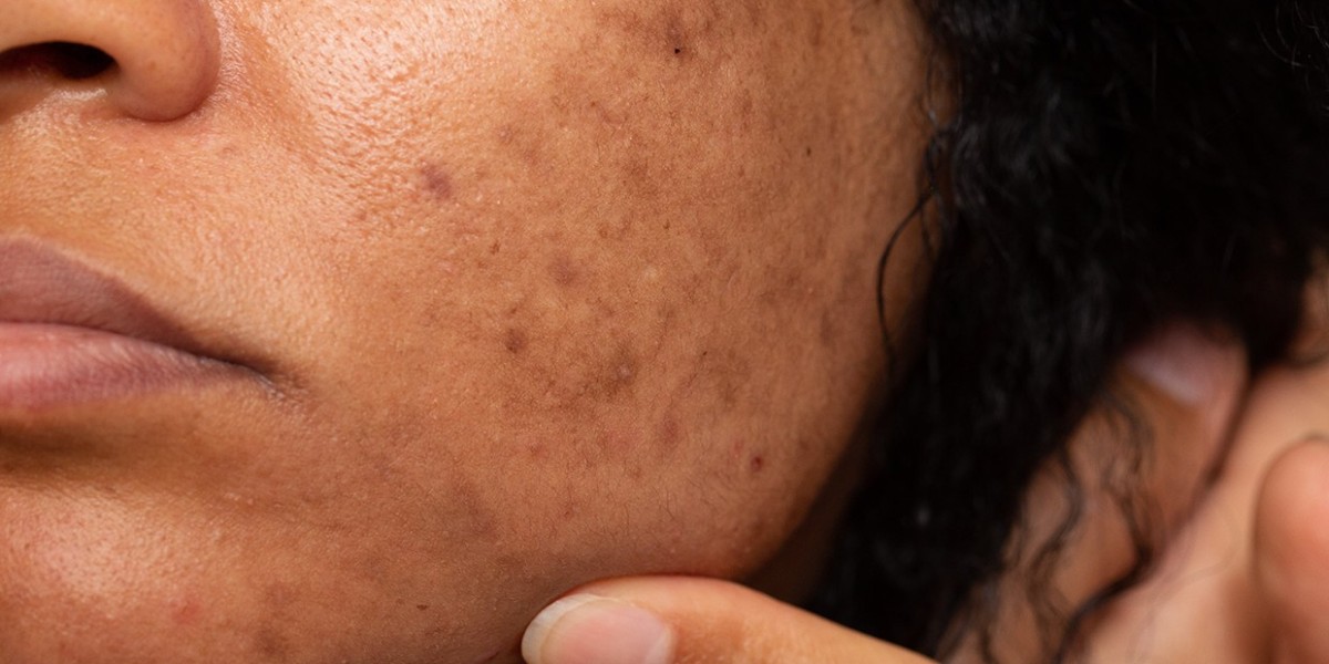 Pico Laser Treatment for Post-Inflammatory Hyperpigmentation (PIH)