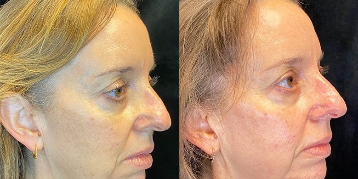 Reversing Aging with Morpheus8: Dubai’s Top Skin Treatment