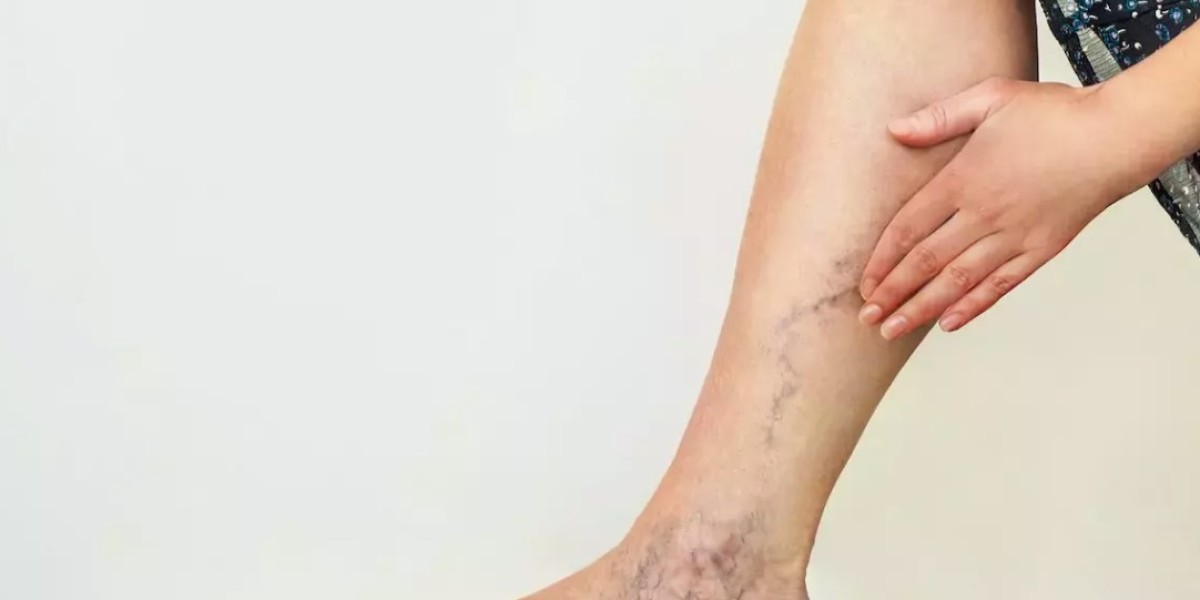 Affordable Spider Veins Solutions in Riyadh