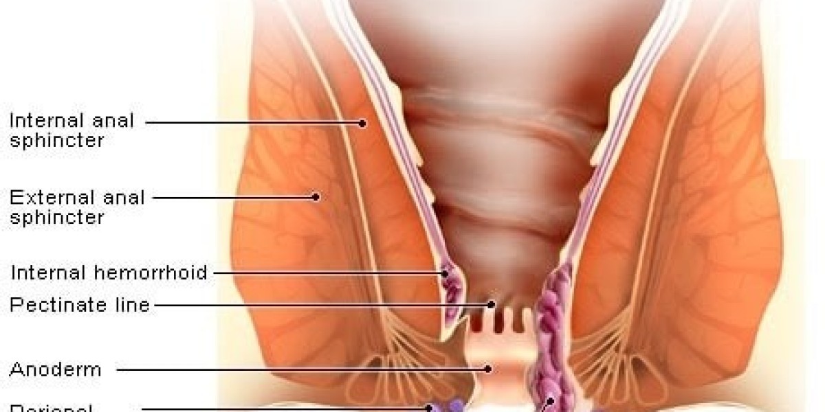Hemorrhoids Treatment in Riyadh: Best Clinics & Care