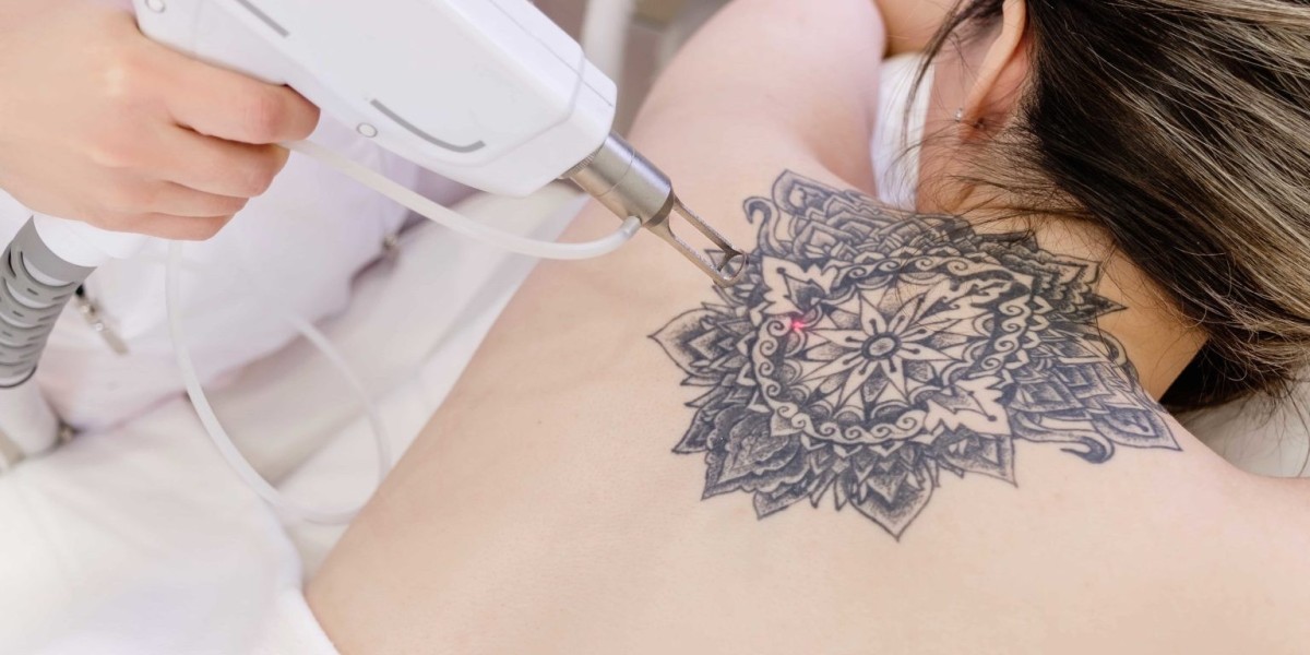 Less Time, More Results – Laser Tattoo Removal That Works!