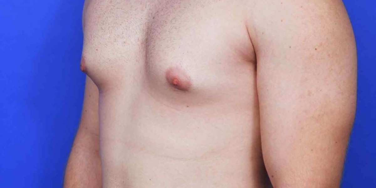 Gynecomastia Surgery in Dubai: What to Expect Before and After