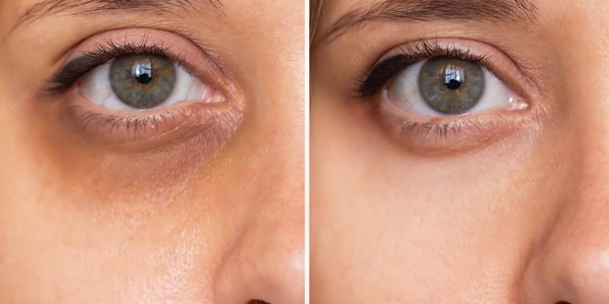 Best Skincare Clinics in Riyadh for Dark Circle Removal