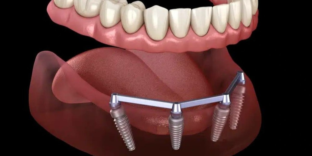 Who Benefits Most from Full Mouth Dental Implants?
