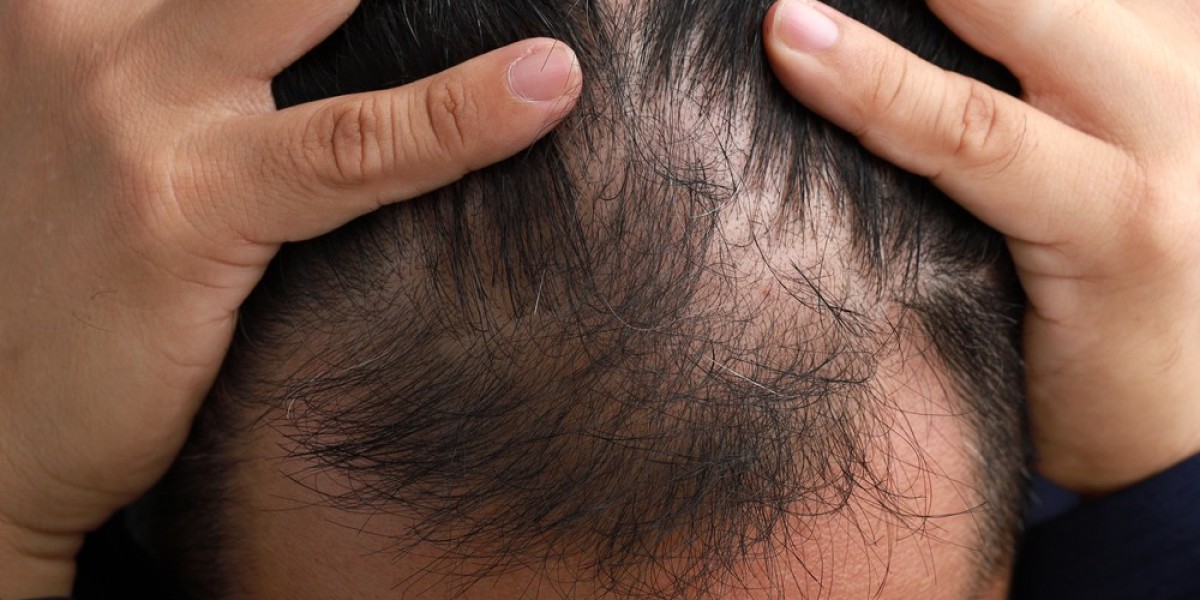 When to Expect Hair Thickening on Finasteride?