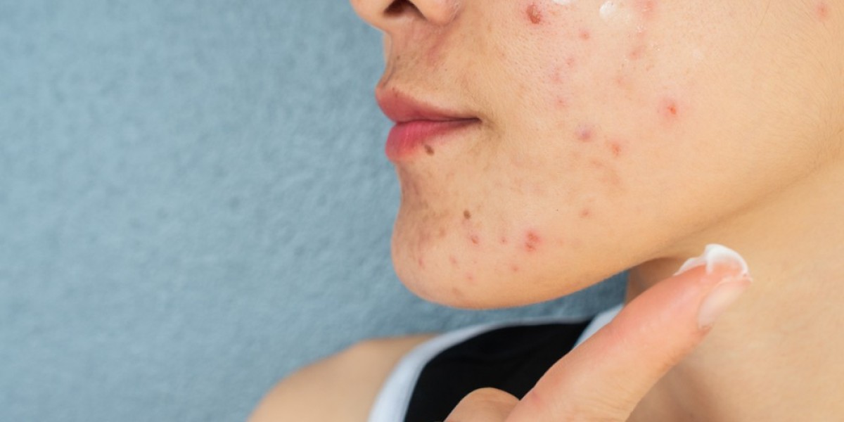 Hydration and Acne: Can Drinking Water Clear Your Skin?