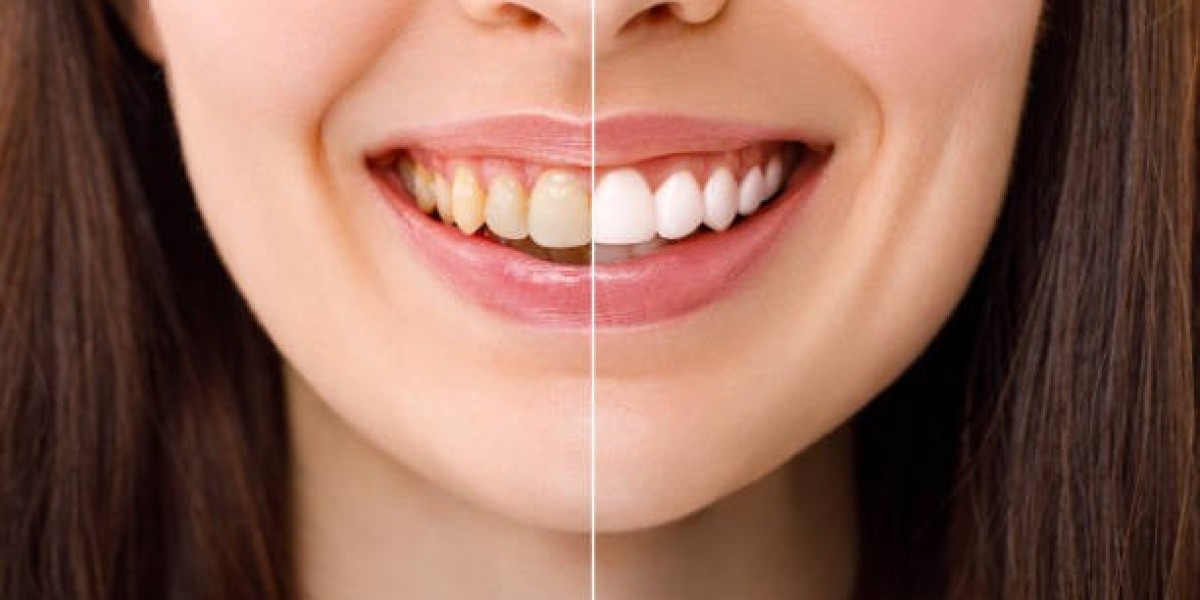 Teeth Cleaning and Polishing in Riyadh – Everything to Know