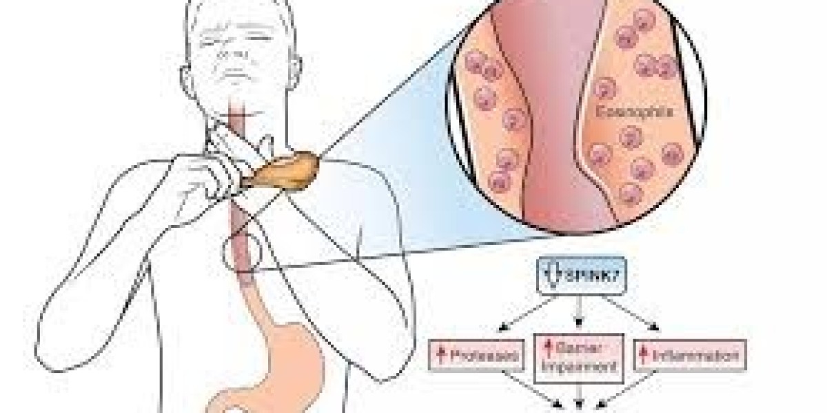 Eosinophilic Esophagitis Market: Rapid Growth and Emerging Therapeutic Innovations