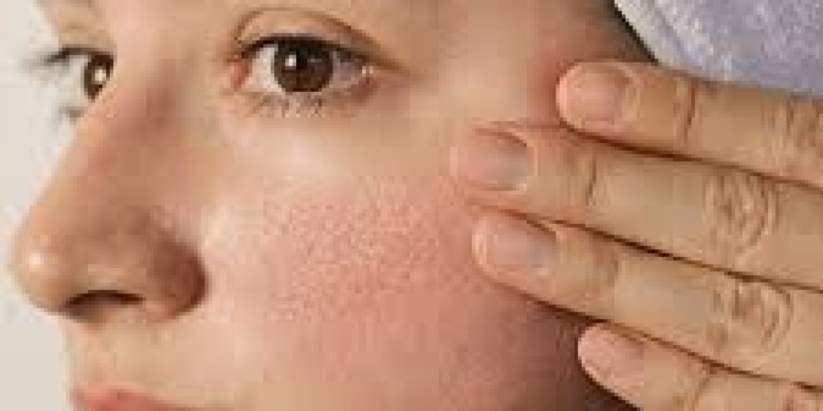 Best Ways to Minimize Large Pores in Islamabad