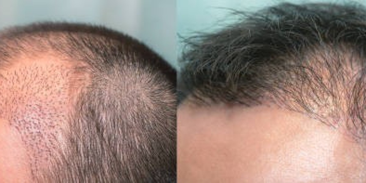 Hair Transplant in Riyadh: Regrow Hair Naturally