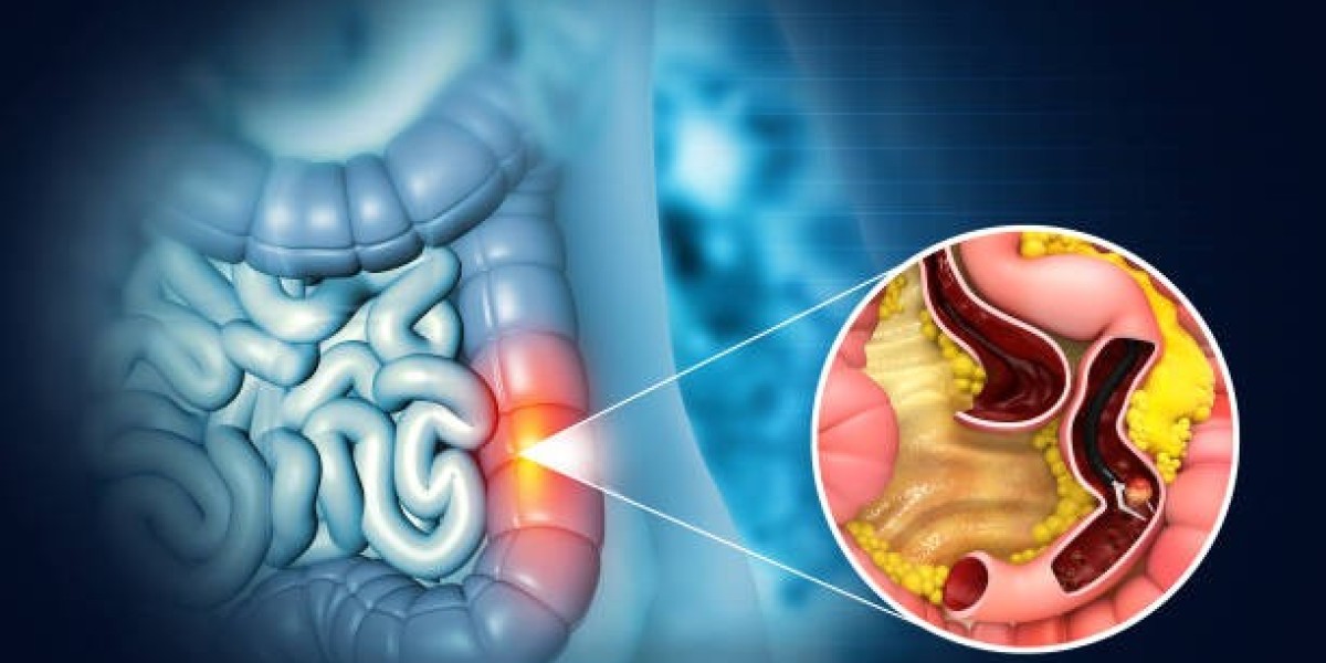 Affordable Hemorrhoids Laser Treatment in Riyadh