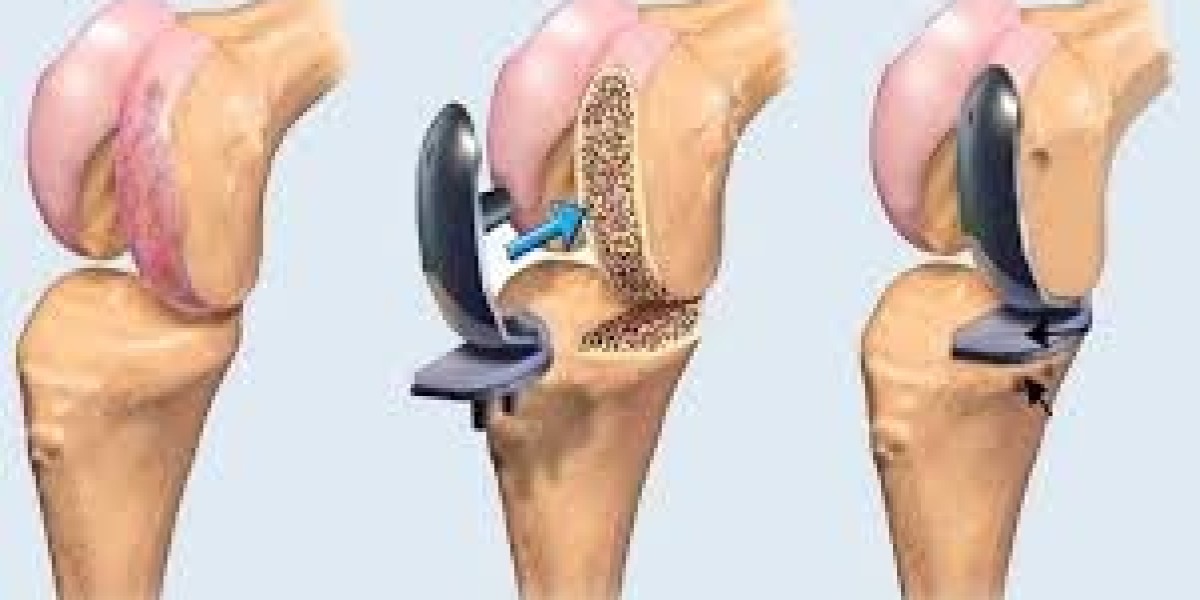Knee Replacement Success Stories: Life After Surgery