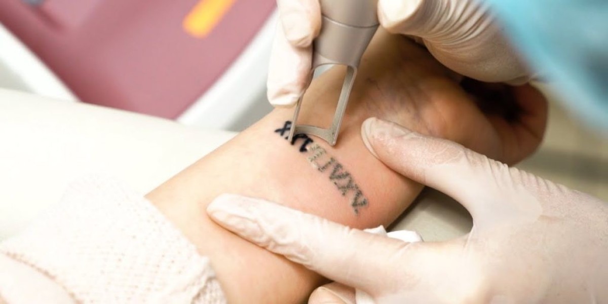 Achieve Clearer Skin with Professional Tattoo Removal Service NYC