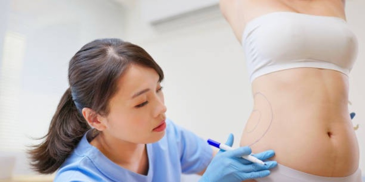 Liposuction Surgery in Riyadh – A Step Closer to Confidence