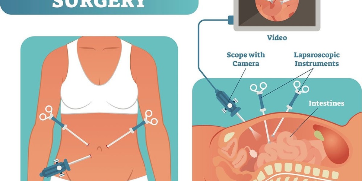 Laser and Laparoscopic Surgery: A Minimally Invasive Approach to Better Health