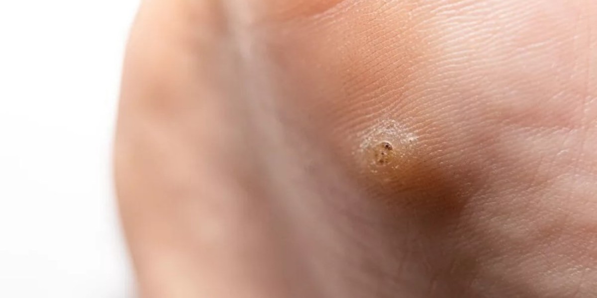 How to Choose Between Different Wart Removal Treatments Based on Cost
