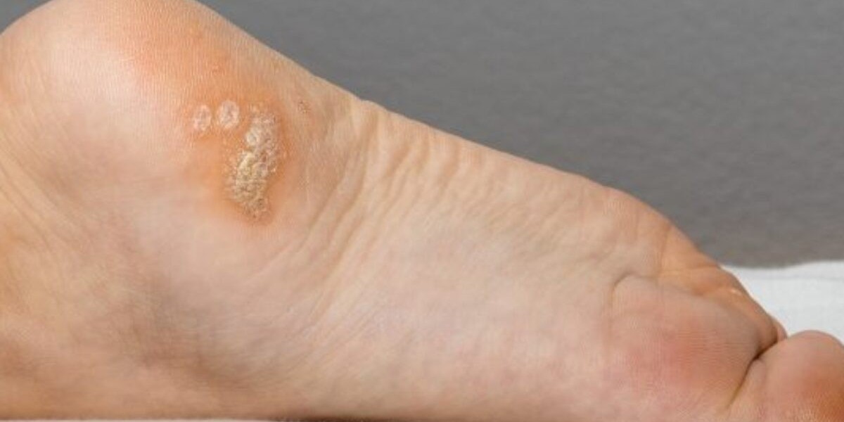 Affordable Wart Removal Treatments: Your Cost-Saving Guide