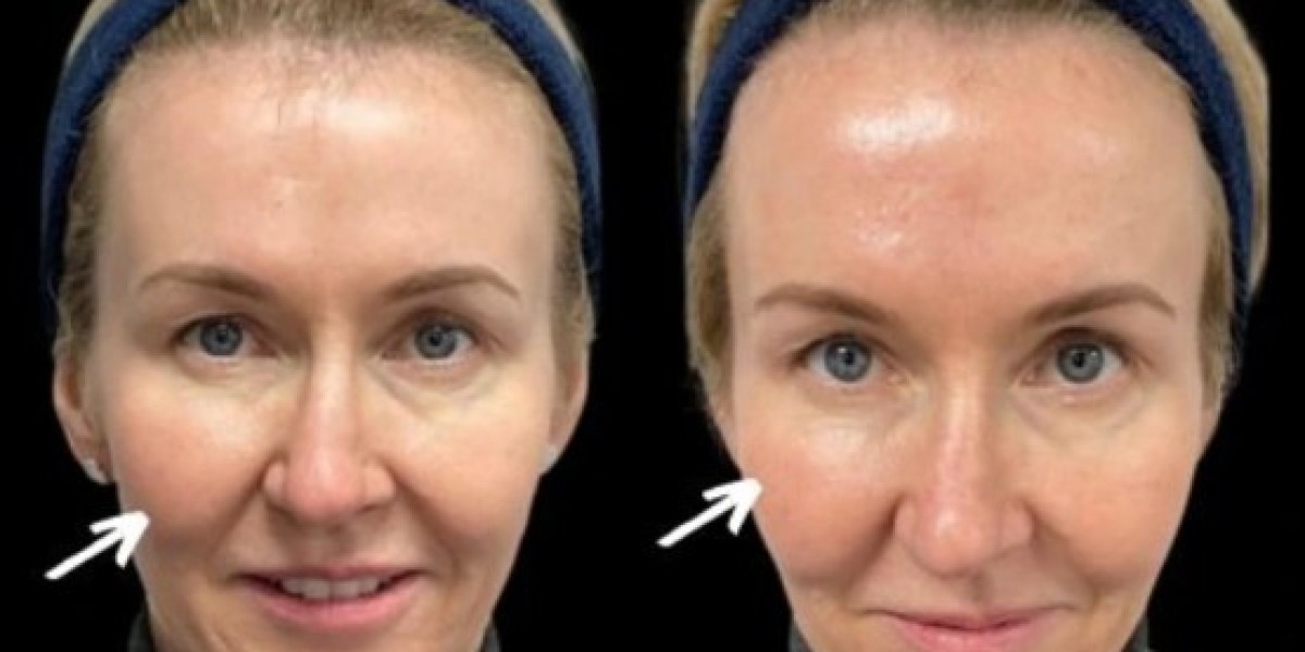 Sculptra Fillers in Dubai for Hand Rejuvenation: The Anti-Aging Secret