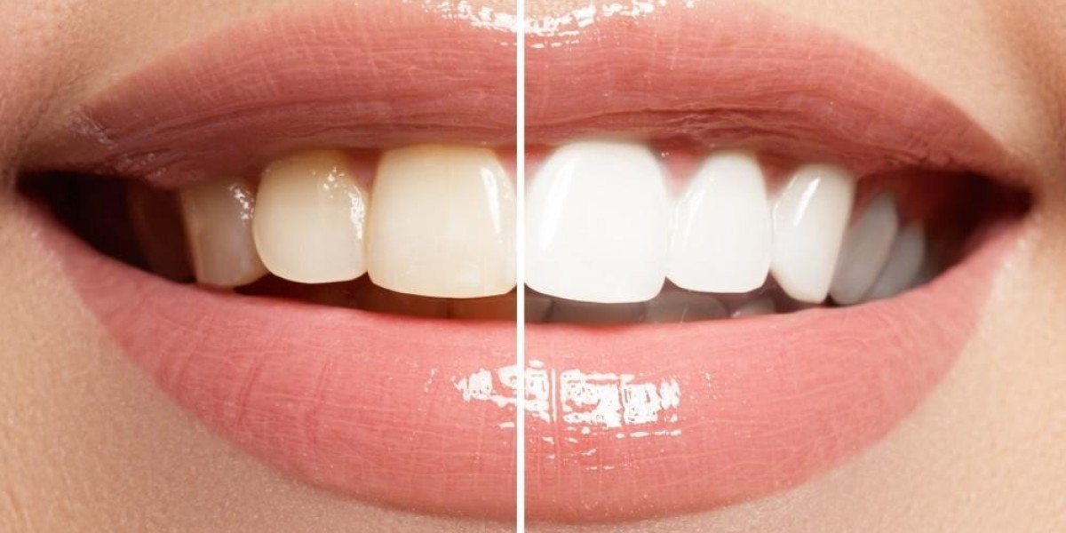 Safe and Effective Teeth Whitening Solutions in Dubai