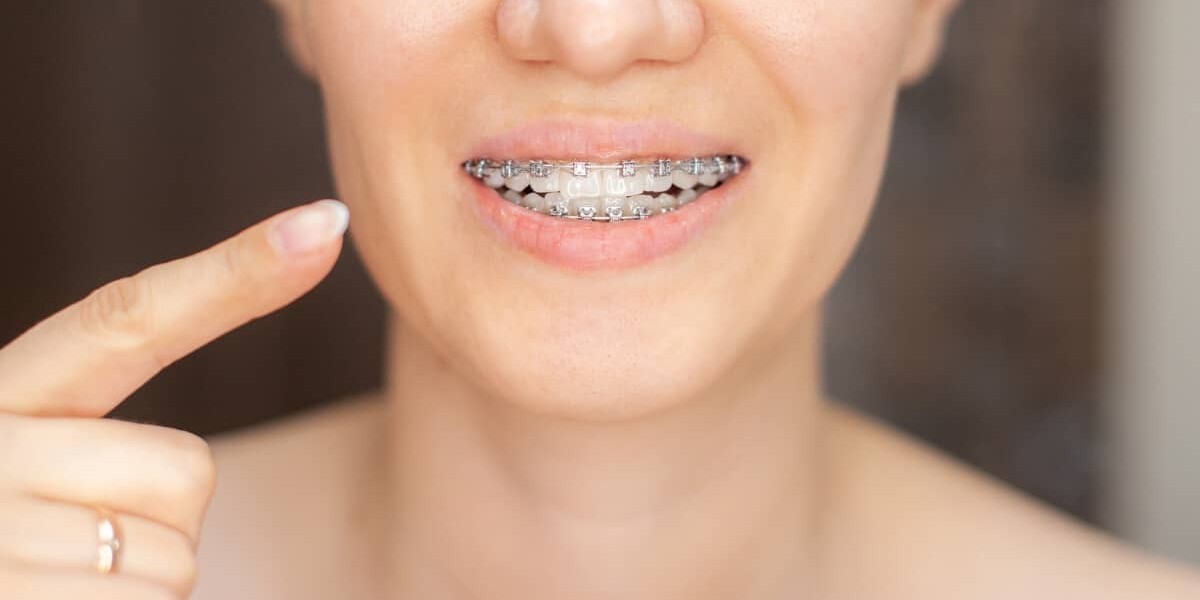 Invisalign Braces Pricing in 2025: What You Should Know Before You Start