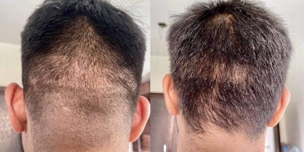 The True Cost of a Hair Transplant: What’s Included and What’s Not