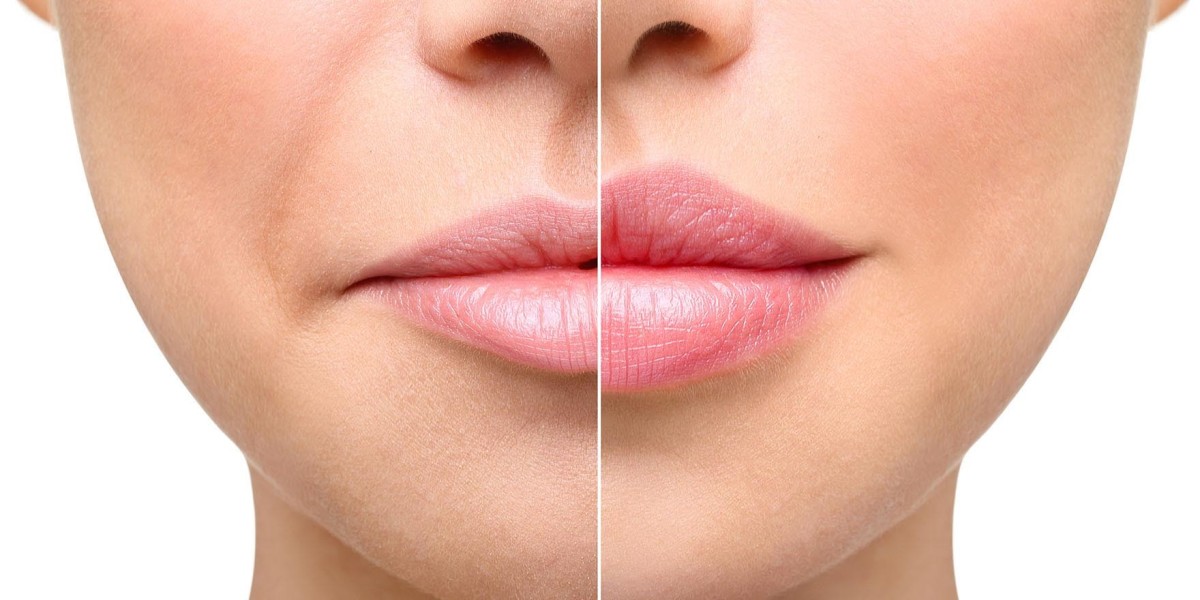 Russian Lip Fillers in Riyadh: Aftercare Tips
