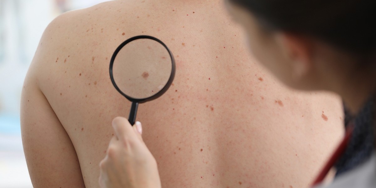 Skin Tag Removal: What You Need to Know About Laser Treatment