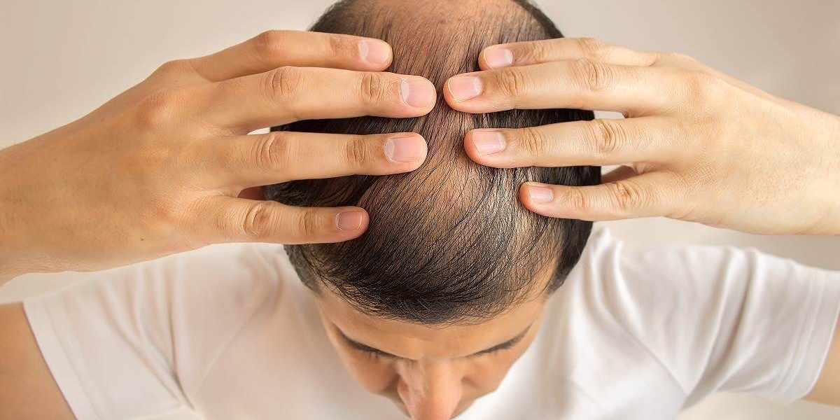 Is Hair Transplant Surgery Expensive? Here’s What You Should Expect