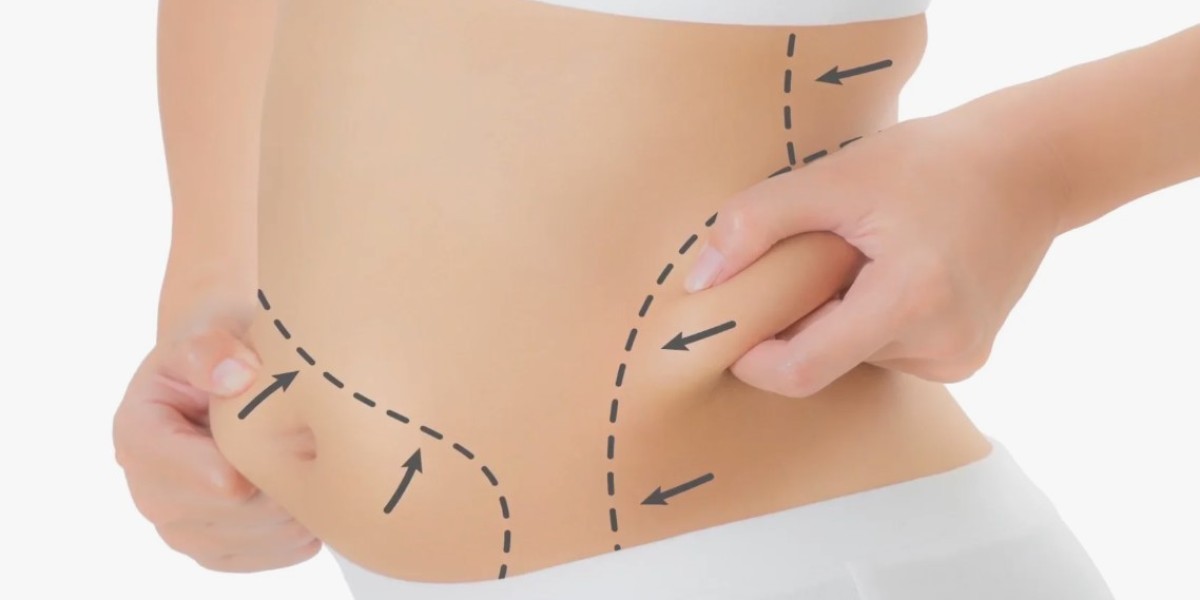 Top Reasons to Consider a Tummy Tuck in Riyadh