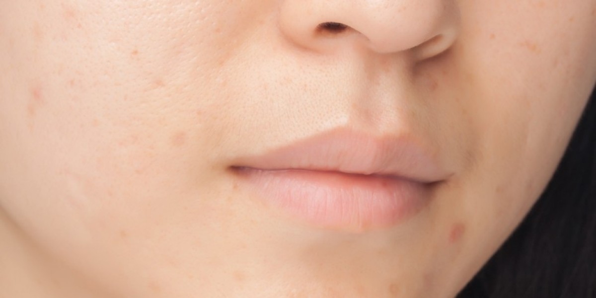 Dark Spot and Acne Scar Removal in Riyadh – Top Options