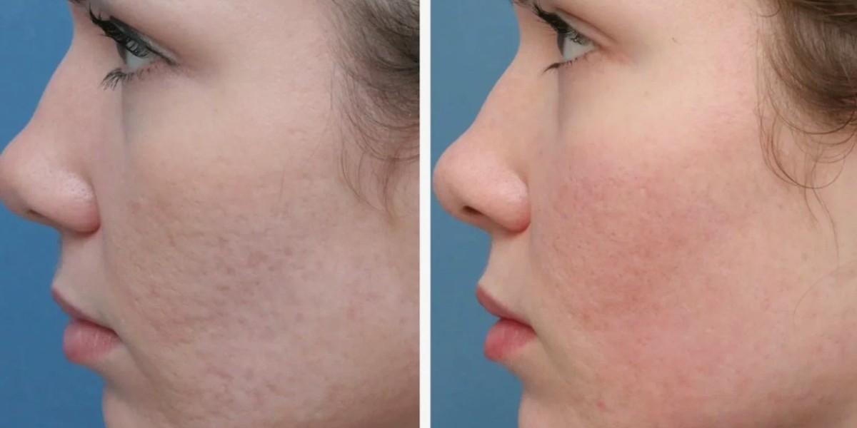 Before and After: Laser Scar Removal Results in Riyadh