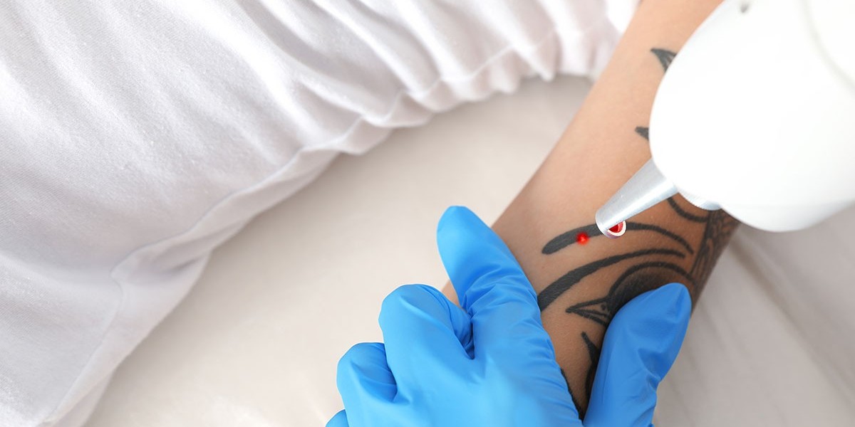 Painless & Precise Laser Tattoo Removal in Dubai
