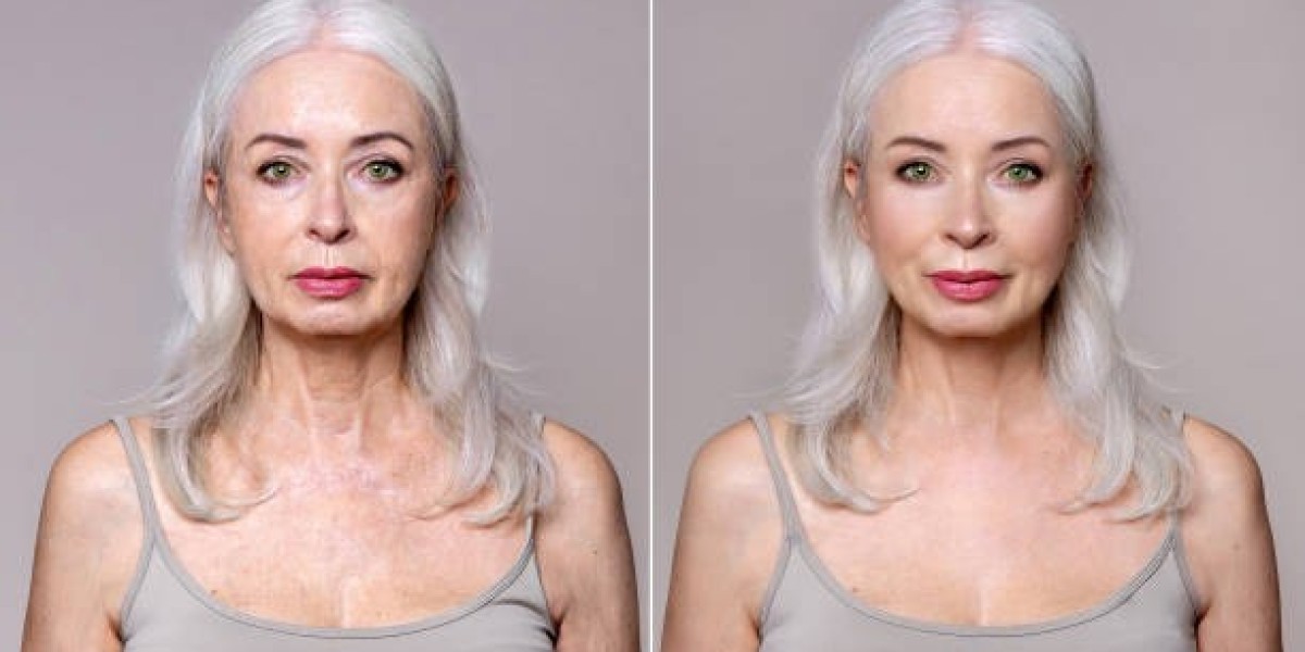 Non-Surgical Face Lift in Riyadh: What to Know