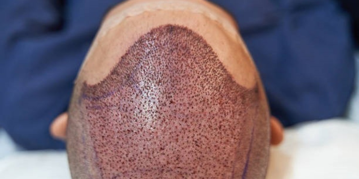5 Myths About Hair Transplant in Riyadh Debunked