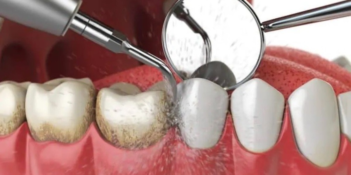 Common Myths About Tooth Extraction in Dubai—Busted!