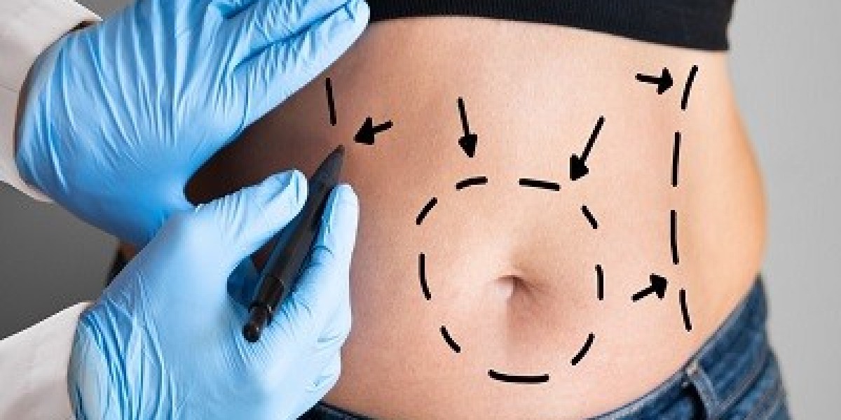 Does Liposuction Leave Scars? What You Should Know