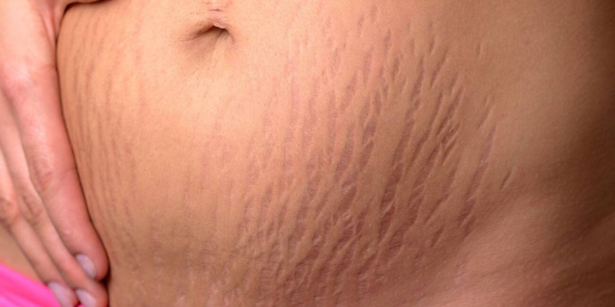 How Effective Is Laser Treatment For Stretch Marks?