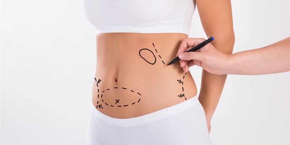 The Ultimate Dubai Liposuction Experience – What You Need to Know