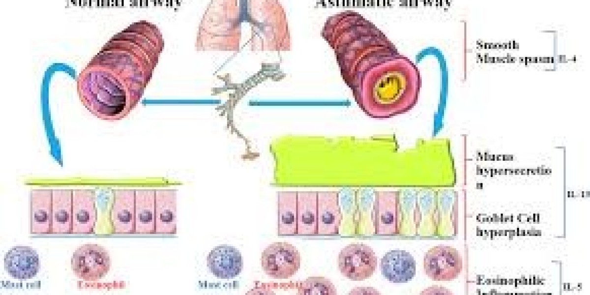 Treatment of Asthma in Elderly Patients: Special Considerations and Strategies