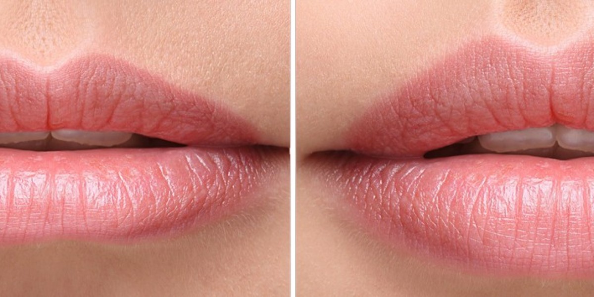 Russian Lip Fillers: The Secret to a Perfect Pout in Riyadh
