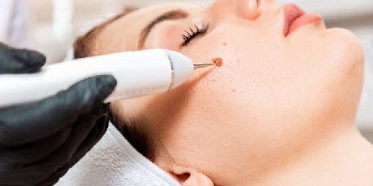 Dubai’s Best Wart Removal Methods – Quick & Easy