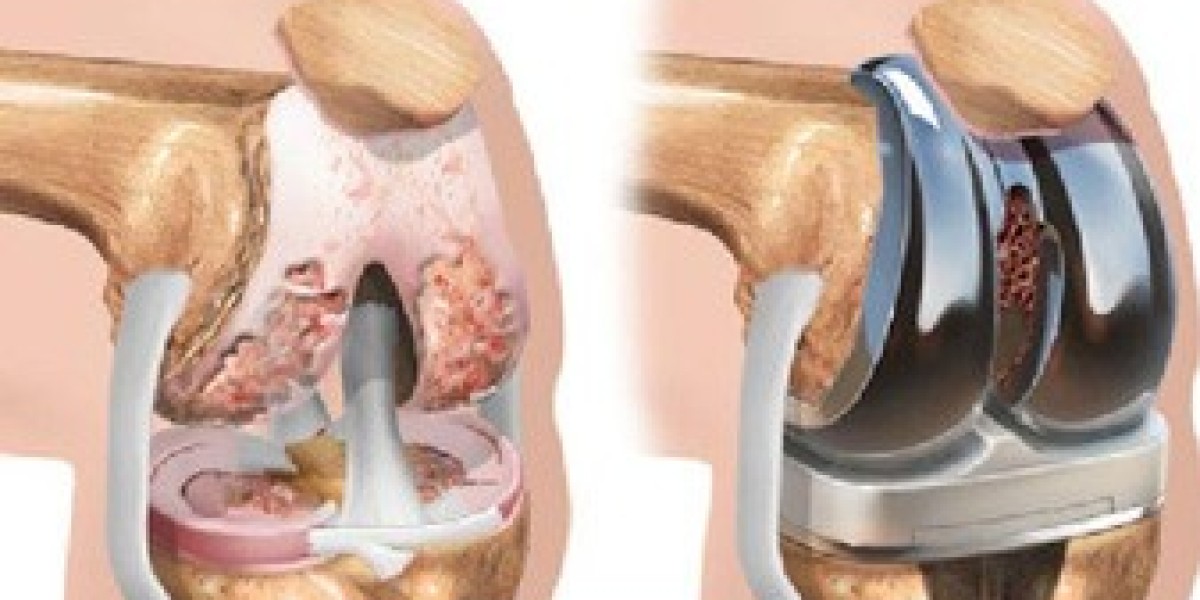 Knee Replacement Surgery: How It Can Change Your Life