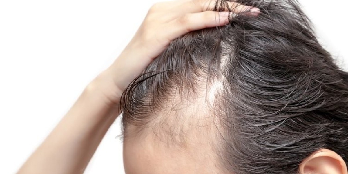 Hair Regrowth on Autopilot: Finasteride’s Unstoppable Power!